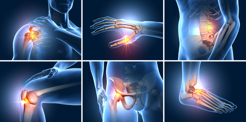 A,Set,Of,Six,Painful,Joints,,Medical,3d,Illustration